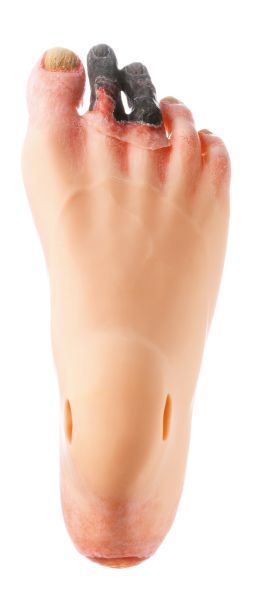 Fuß, rechts mit Dekubitus und Malperforans
