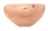 Bauchdecke mit PEG-Öffnung Bauchdecke mit PEG-Öffnung