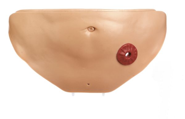 Abdominal cavity cover with anus praeter
